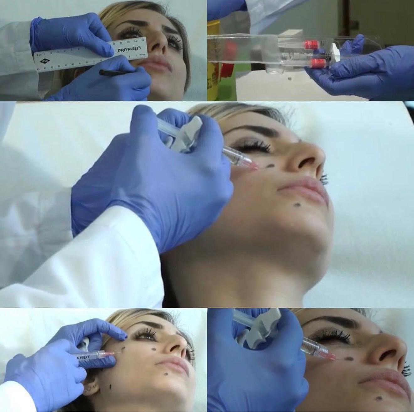 MESOTHERAPIE